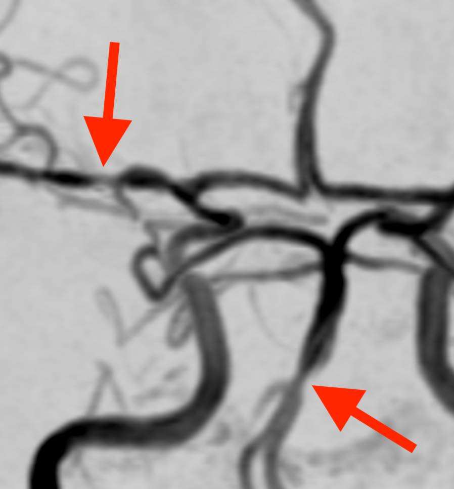 咳やくしゃみで可逆性脳血管攣縮症候群