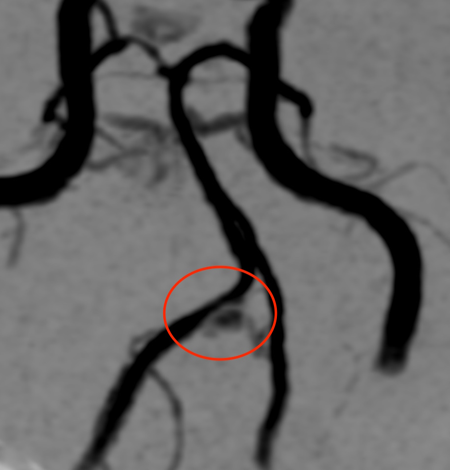 解離性脳動脈瘤