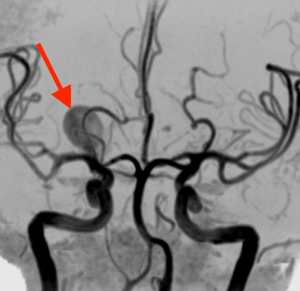 巨大未破裂脳動脈瘤