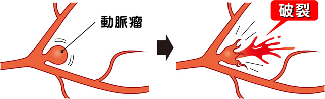 脳動脈瘤破裂