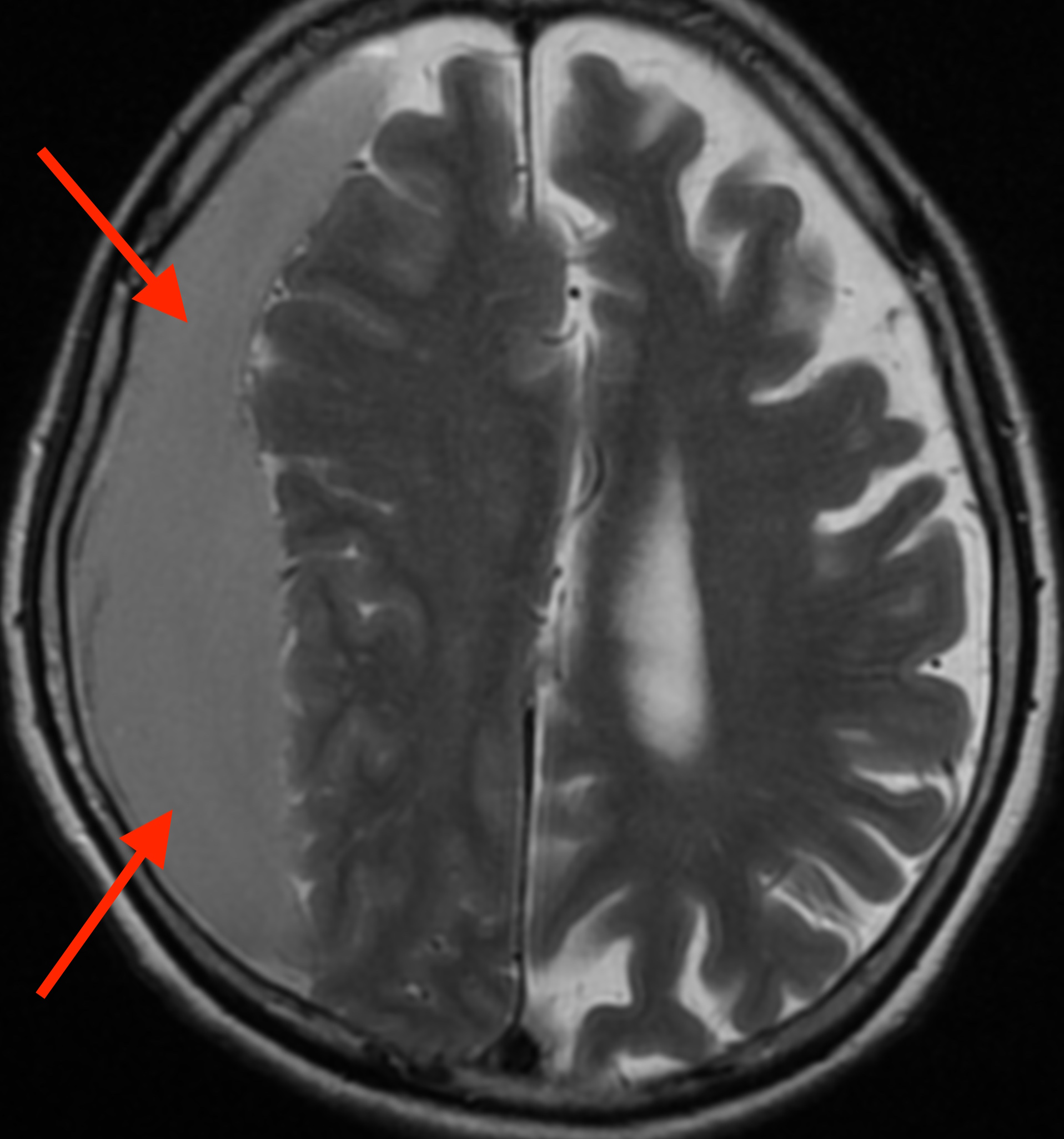 高齢者の慢性硬膜下血腫