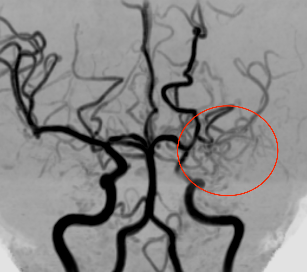 左もやもや血管