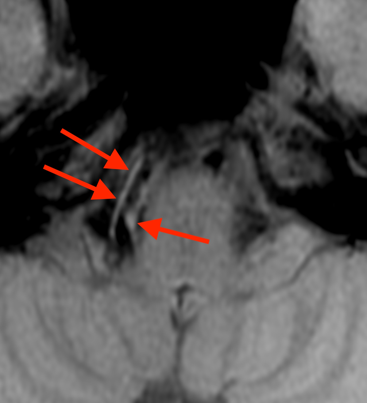 椎骨動脈解離_T1BB
