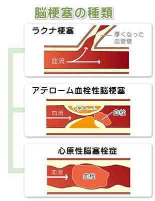 脳梗塞の種類