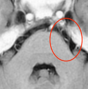 三叉神経入口部
