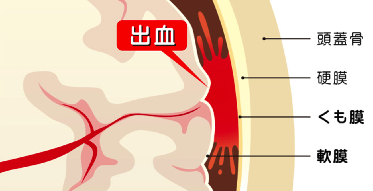 クモ膜下出血