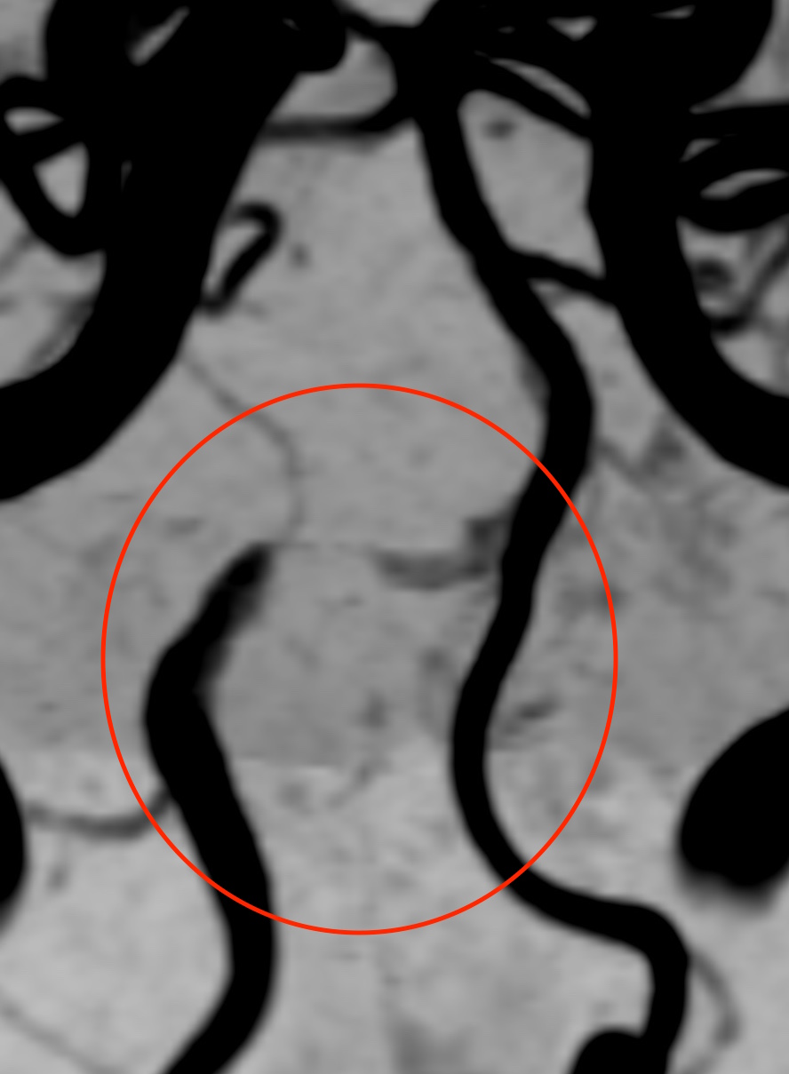 椎骨動脈解離_MIP