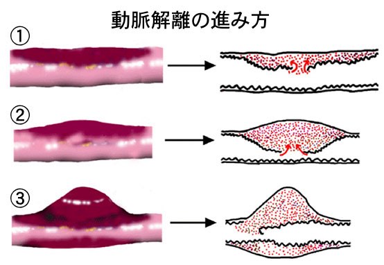 椎骨動脈解離のメカニズム