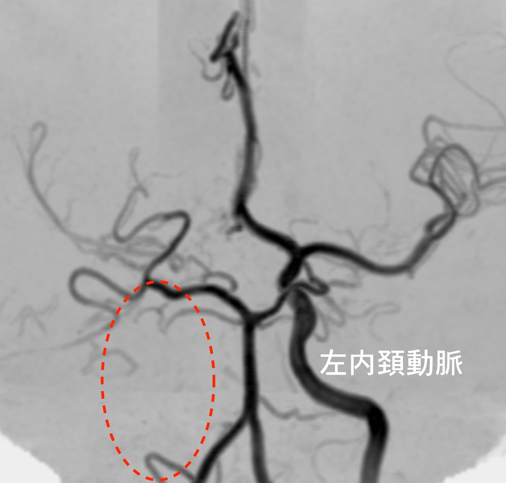右ICA-MCA描出なし