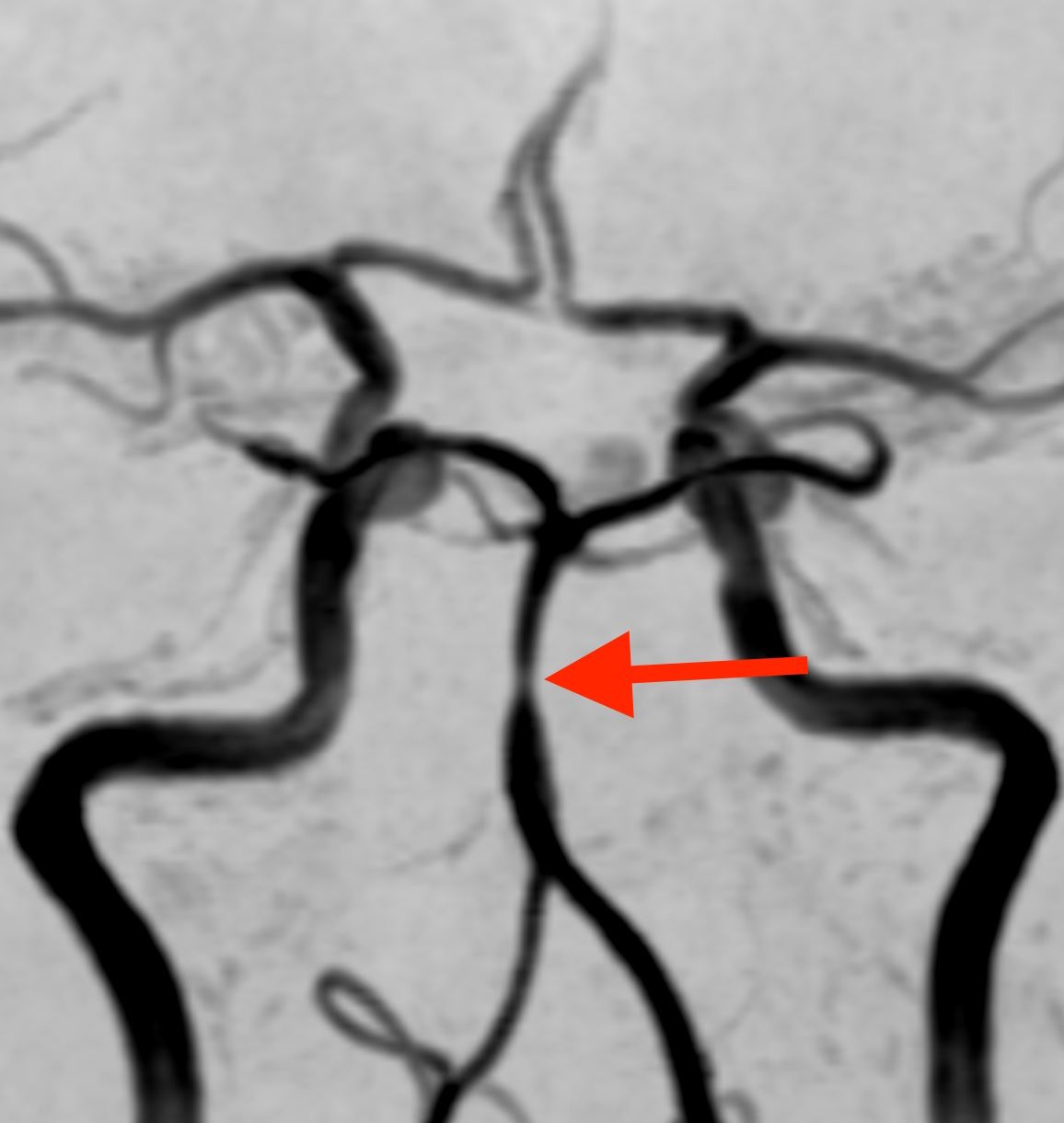 脳底動脈の攣縮