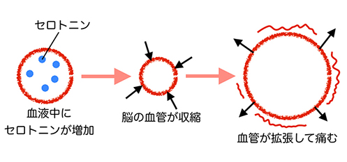 片頭痛の血管収縮と拡張